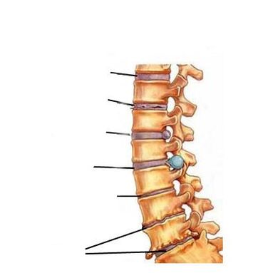 Osteochondrozės vystymosi etapai