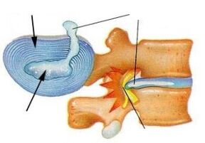 Pluoštinio žiedo sunaikinimas gimdos kaklelio osteochondroze