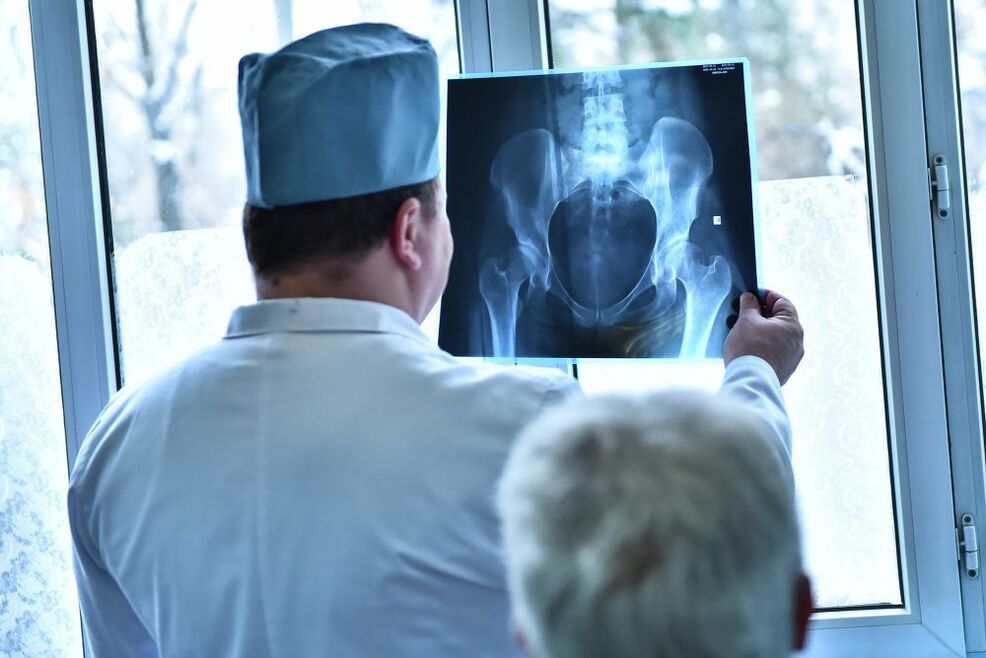 Gydytojas žiūri į klubo sąnario su artroze nuotrauką
